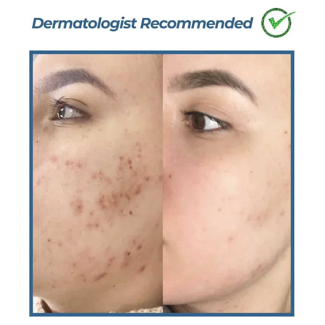 Purex Face Wash For Dry & Acne  Prone Skin | Oleanolic Acid, NDGA & Niacinamide| 120ml GG Organics