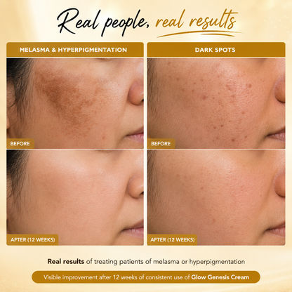 Glow Genesis Cream | Skin Lightening Treatment | 50 gm
