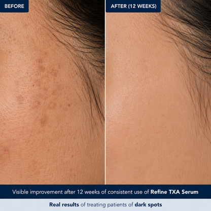 Refine TXA Serum | 30ml