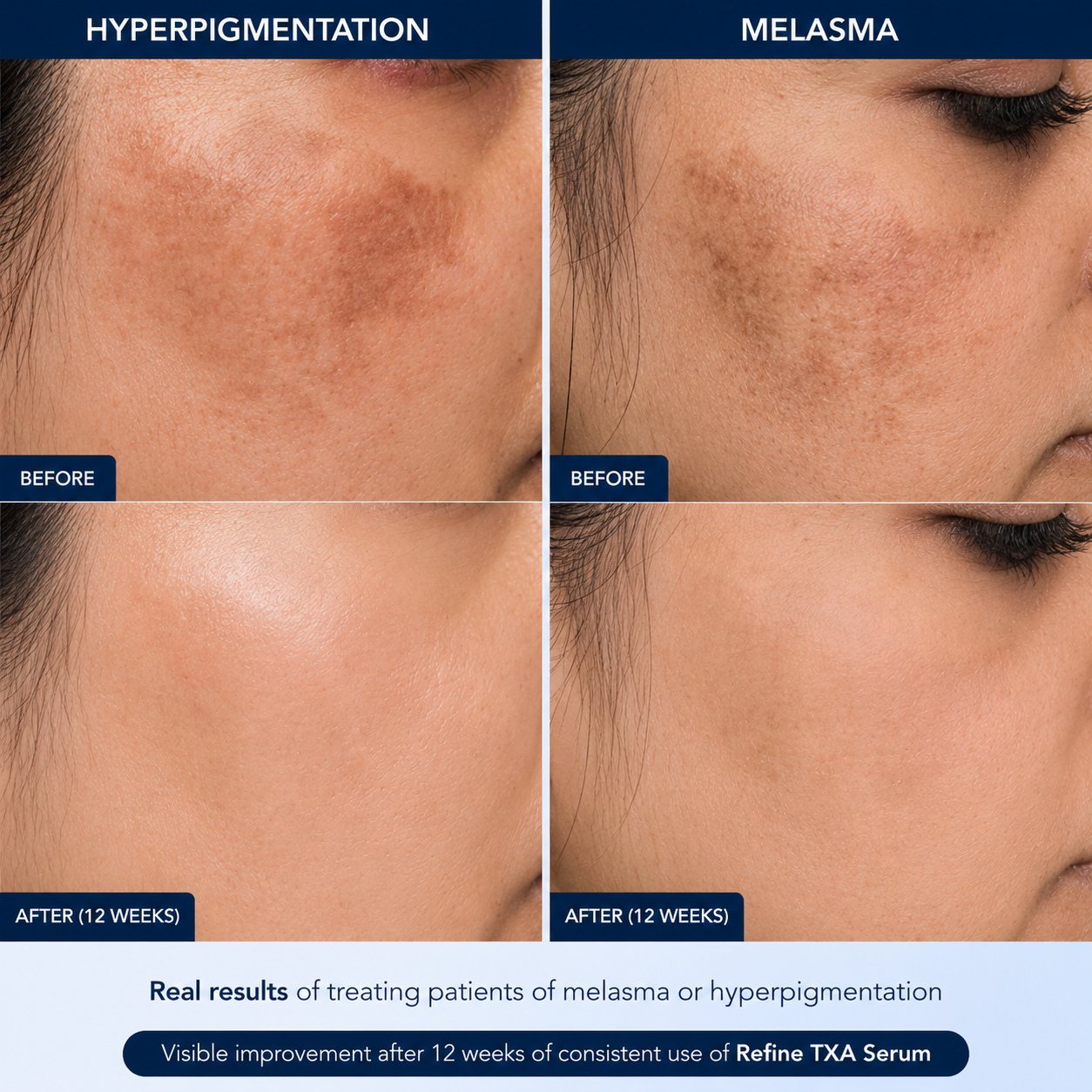 Refine TXA Serum | 30ml