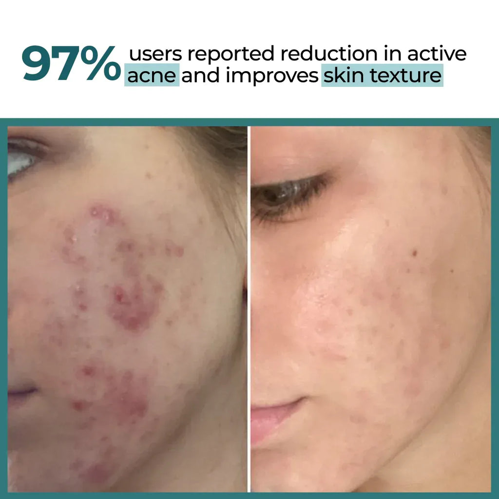 Defensor | Acne Treatment Serum | Salicylic Acid - Azelaic Acid & Glycolic Acid | 30ml