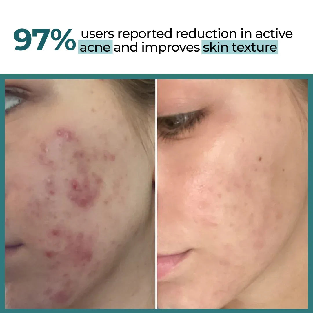 Defensor | Acne Treatment Serum | Salicylic Acid - Azelaic Acid & Glycolic Acid | 30ml